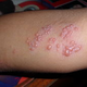 Illustration for article titled Obat Penyakit Herpes Ampuh Manjurem/em